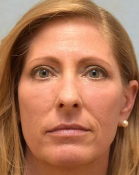 After Results for Blepharoplasty, Laser Skin Resurfacing, Fat Transfer