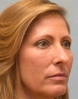 After Results for Blepharoplasty, Laser Skin Resurfacing, Fat Transfer