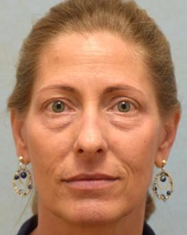 Before Results for Blepharoplasty, Laser Skin Resurfacing, Fat Transfer