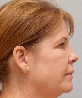 After Results for Mohs Surgery Reconstruction, Skin Cancer Reconstruction, Nose Reconstruction