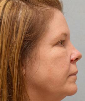 Before Results for Mohs Surgery Reconstruction, Skin Cancer Reconstruction, Nose Reconstruction