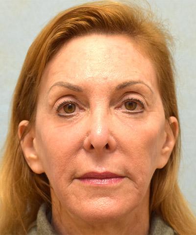 After Results for Laser Skin Resurfacing