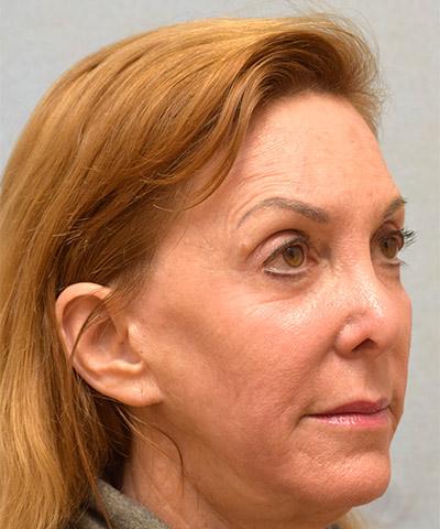 After Results for Laser Skin Resurfacing