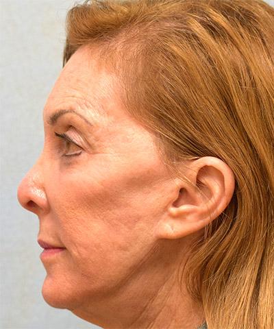 After Results for Laser Skin Resurfacing