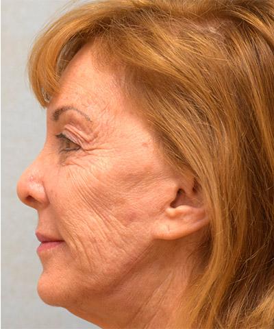 Before Results for Laser Skin Resurfacing