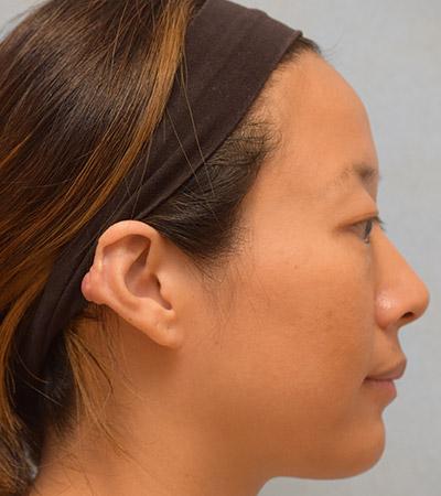 Before Results for Keloid Removal