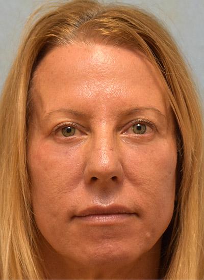 After Results for Blepharoplasty, Laser Skin Resurfacing, Fat Transfer