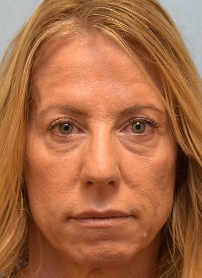 Before Results for Blepharoplasty