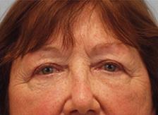 After Results for Blepharoplasty, Fat Transfer