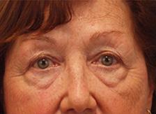 Before Results for Blepharoplasty, Fat Transfer