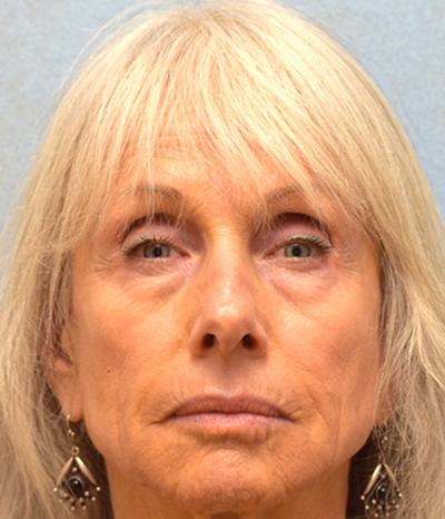 After Results for Juvederm
