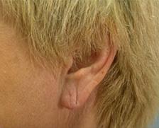 After Results for Earlobe Repair