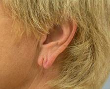 Before Results for Earlobe Repair