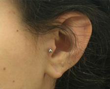 After Results for Earlobe Repair