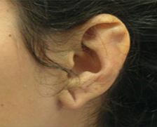 Before Results for Earlobe Repair