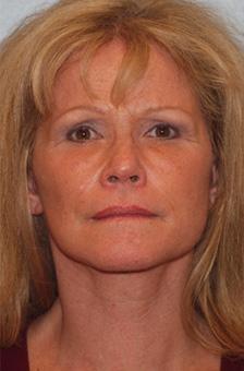 After Results for Facelift