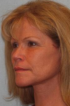 After Results for Blepharoplasty, Facelift, Fat Transfer, Necklift