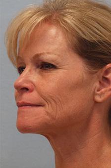 Before Results for Blepharoplasty, Facelift, Fat Transfer, Necklift