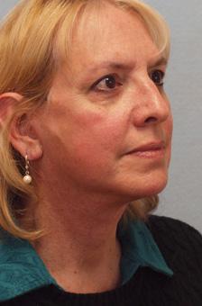 After Results for Facelift