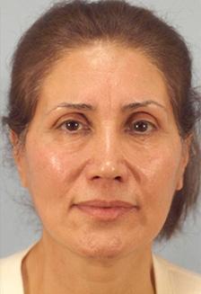 After Results for Facelift