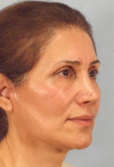 After Results for Facelift