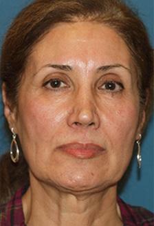 Before Results for Facelift