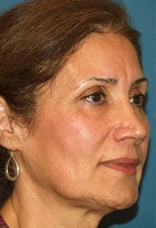 Before Results for Facelift