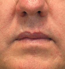 After Results for Facial Trauma