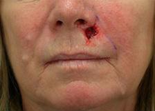 Before Results for Mohs Surgery Reconstruction, Skin Cancer Reconstruction