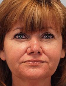 After Results for Mohs Surgery Reconstruction, Skin Cancer Reconstruction, Nose Reconstruction