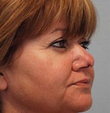 After Results for Mohs Surgery Reconstruction, Skin Cancer Reconstruction, Nose Reconstruction