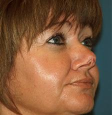 Before Results for Mohs Surgery Reconstruction, Skin Cancer Reconstruction, Nose Reconstruction