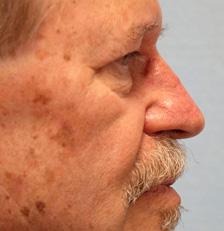 After Results for Nose Reconstruction