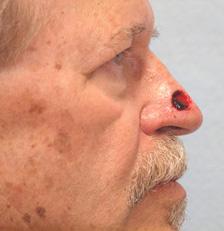 Before Results for Mohs Surgery Reconstruction, Skin Cancer Reconstruction, Nose Reconstruction