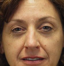 After Results for Mohs Surgery Reconstruction, Skin Cancer Reconstruction, Nose Reconstruction