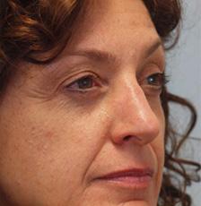After Results for Mohs Surgery Reconstruction, Skin Cancer Reconstruction, Nose Reconstruction