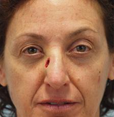 Before Results for Mohs Surgery Reconstruction, Skin Cancer Reconstruction, Nose Reconstruction