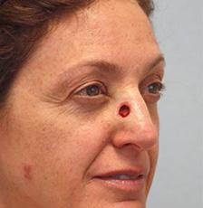 Before Results for Mohs Surgery Reconstruction, Skin Cancer Reconstruction, Nose Reconstruction