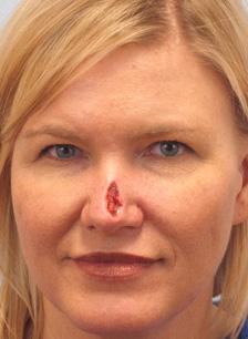 Before Results for Mohs Surgery Reconstruction, Skin Cancer Reconstruction, Nose Reconstruction