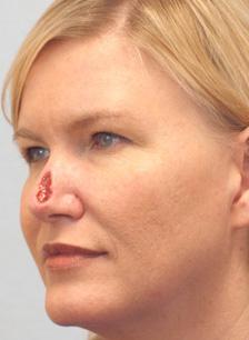 Before Results for Mohs Surgery Reconstruction, Skin Cancer Reconstruction, Nose Reconstruction