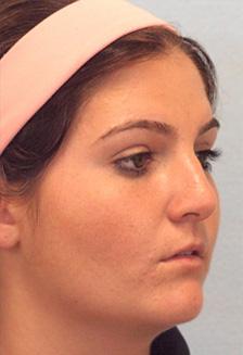 After Results for Rhinoplasty