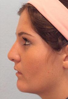 After Results for Rhinoplasty