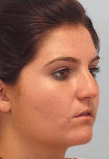 Before Results for Rhinoplasty