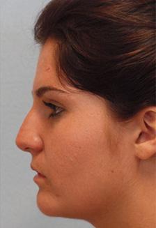 Before Results for Rhinoplasty