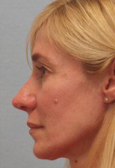 After Results for Rhinoplasty