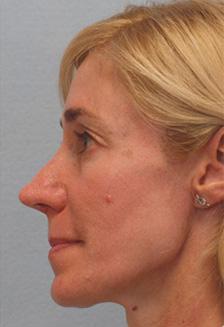 Before Results for Rhinoplasty