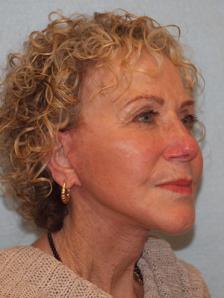 After Results for Facelift