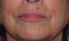 Before Results for Juvederm, Radiesse