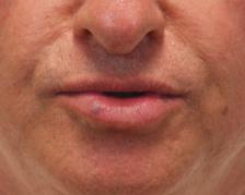 Before Results for Mole Removal