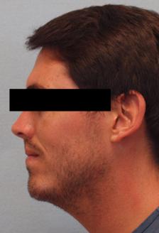 After Results for Chin Implant